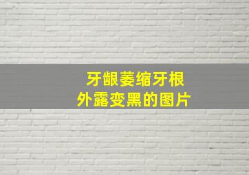 牙龈萎缩牙根外露变黑的图片